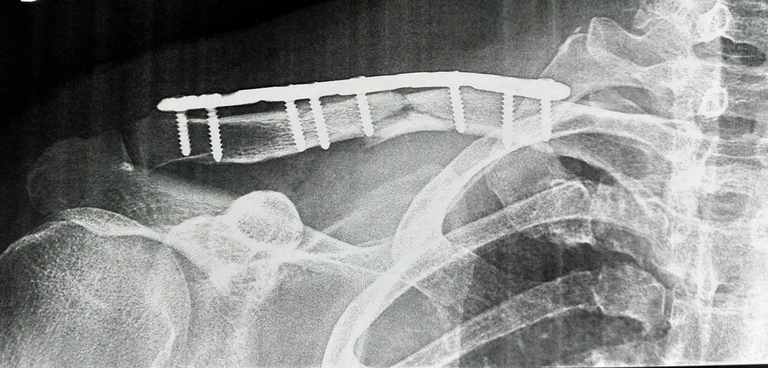 fracture-clavicule-après2