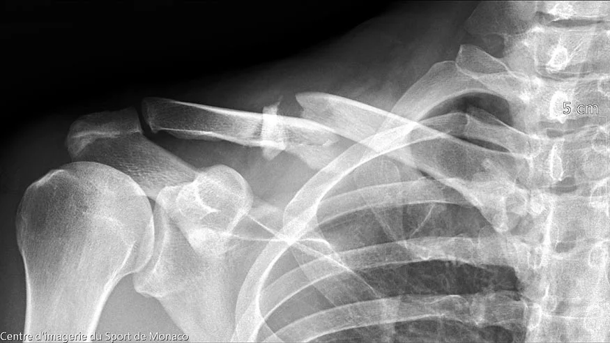 fracture-clavicule-avant