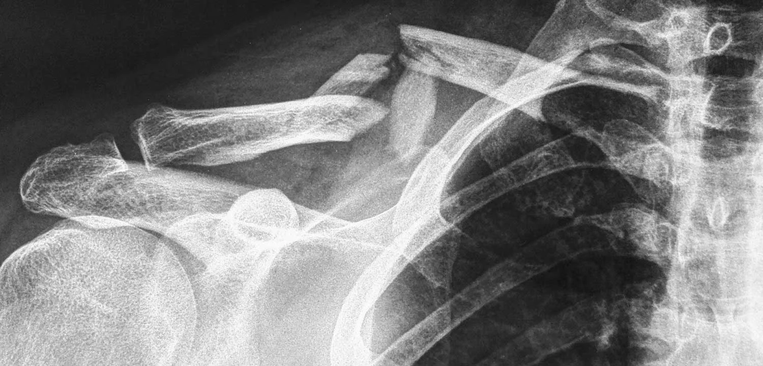 fracture-clavicule-avant2