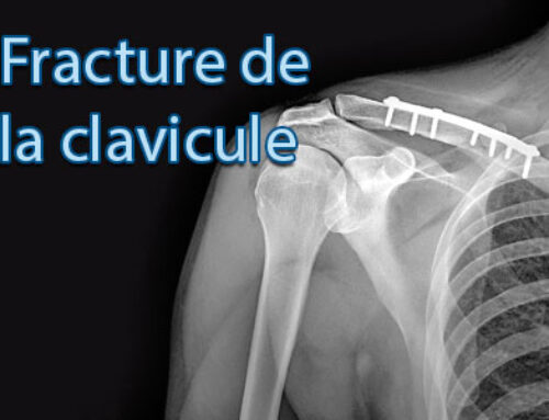 Fracture de la Clavicule