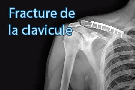 Fracture de la Clavicule