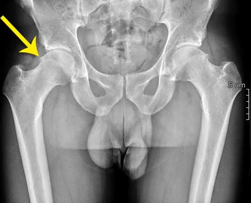 L’arthroscopie de hanche