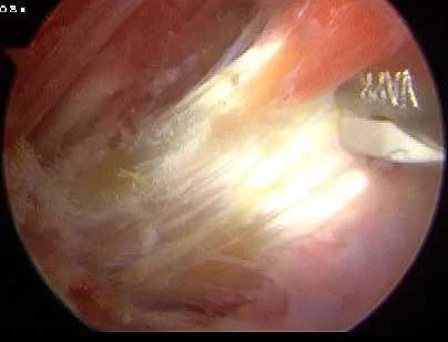 L’arthroscopie de hanche