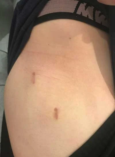 L’arthroscopie de hanche