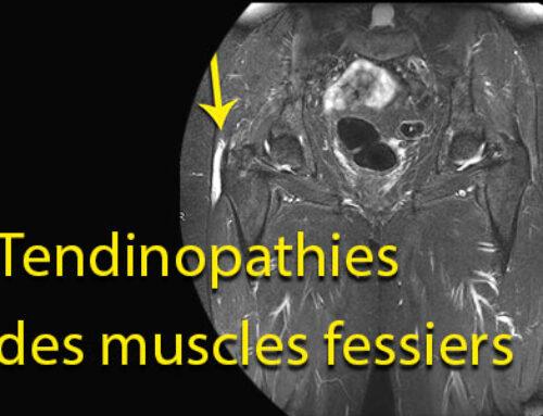 Tendinopathies des muscles fessiers