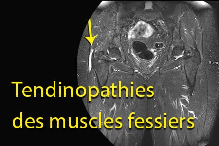 thumb-tendinopathies-des-muscles-fessiers