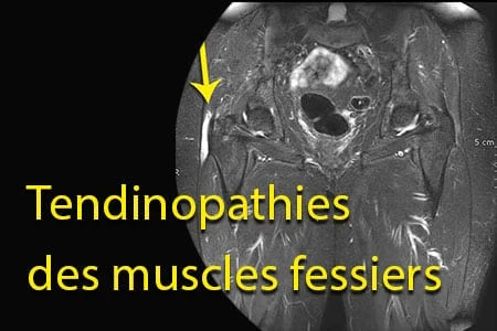 Tendinopathies des muscles fessiers