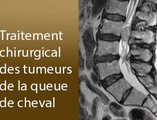 Traitement chirurgical des tumeurs de la queue de cheval