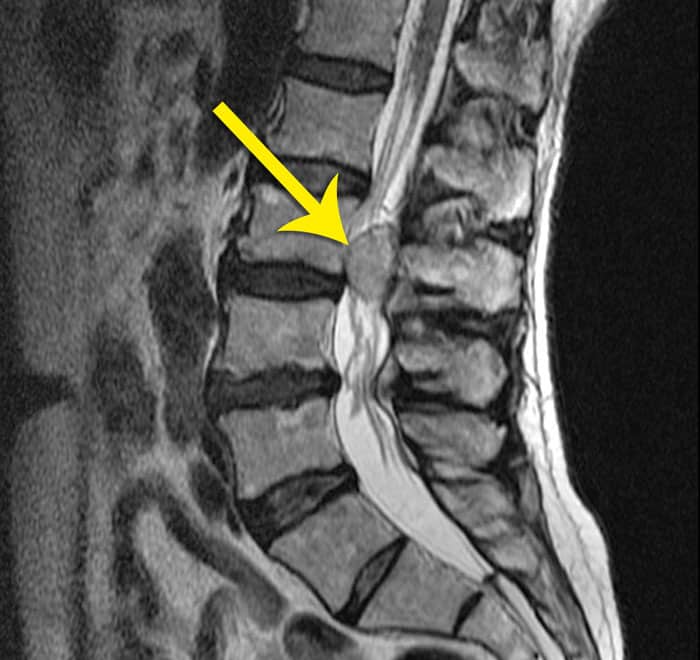 Traitement chirurgical des tumeurs de la queue de cheval - IM2S