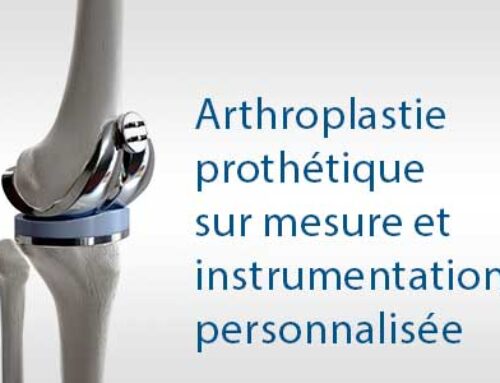 Arthroplastie prothétique sur mesure et instrumentation personnalisée