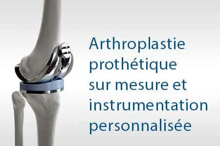 thumb-arthroplastie-protetique-genou-personnalise Arthroplastie prothétique sur mesure et instrumentation personnalisée