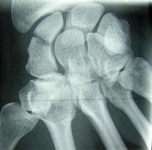 fracture-scaphoide