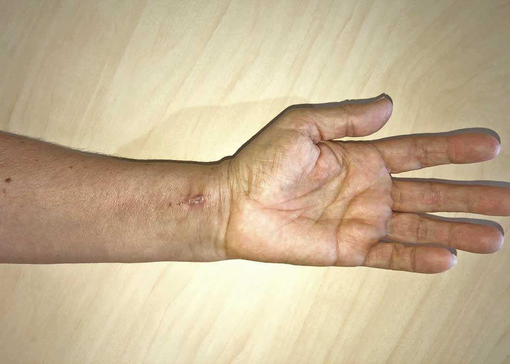 Fracture du poignet - cicatrice à 3 semaines