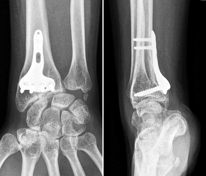 Fracture du poignet - IM2S