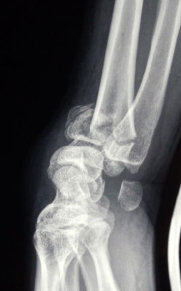 fracture-poignet-radio-avant-2