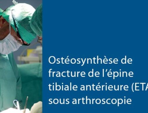 Ostéosynthèse de fracture de l’épine tibiale antérieure (ETA) sous arthroscopie