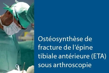 thumb-ETA Ostéosynthèse de fracture de l’épine tibiale antérieure (ETA) sous arthroscopie