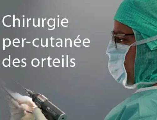 Chirurgie per-cutanée des orteils