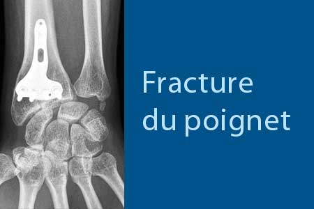 thumb-fracture-poignet