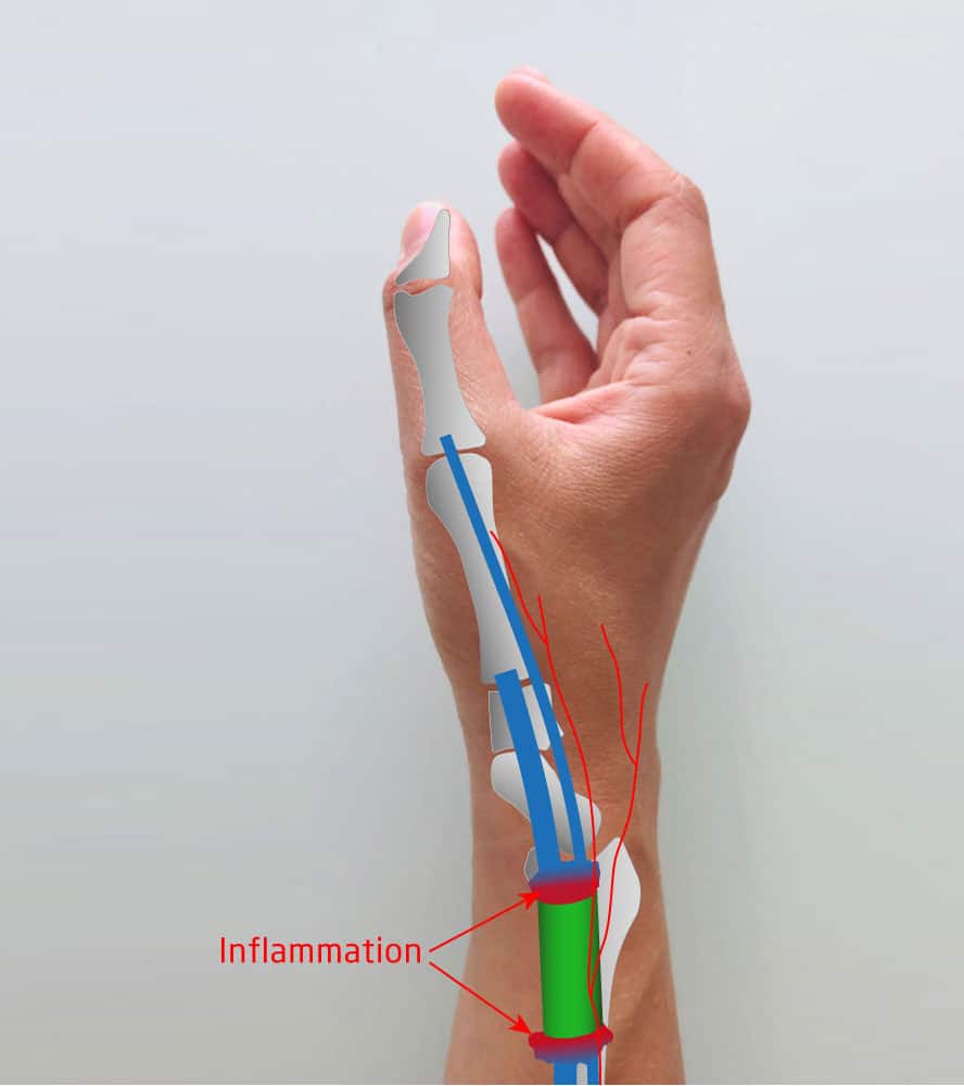 La tendinite de De Quervain - IM2S