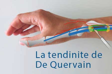 thumb-de-quervain