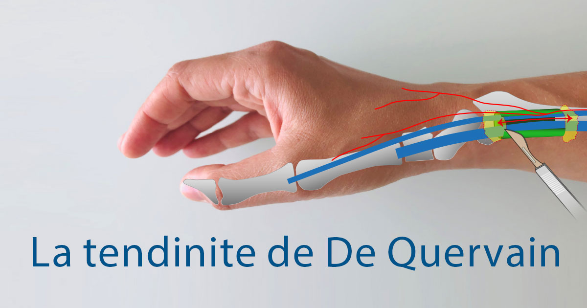 Tendinite du Pouce ou Ténosynovite de De Quervain - Groupe Clinique Drouot