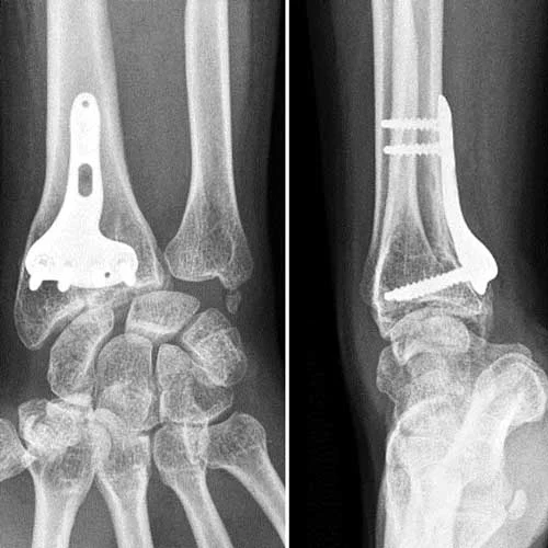 poignet-chirurgie-1 poignet-chirurgie