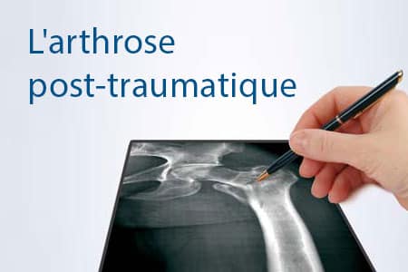 thumb-arthrose-post-traumatique