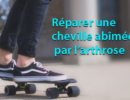 Réparer une cheville abîmée par l’arthrose