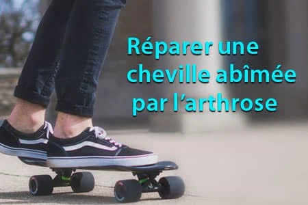 Réparer une cheville abîmée par l’arthrose