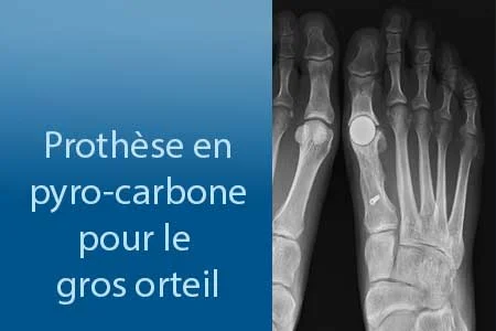 thumb-prothese-orteil-pyro-carbone