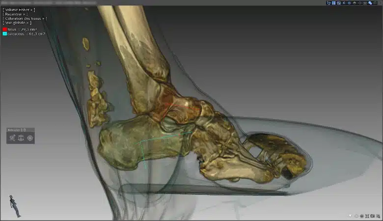 pied-creux-chirurgie-assistee-ordinateur-3d-1