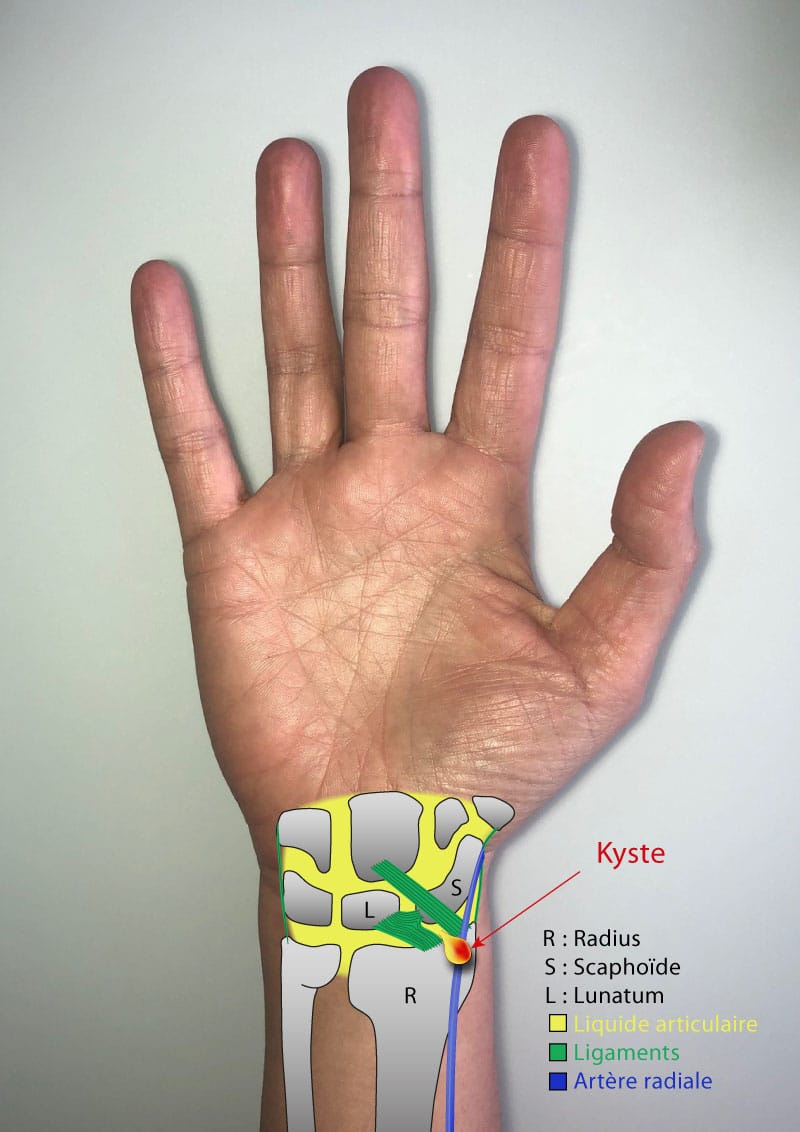 Le kyste synovial du poignet - IM2S