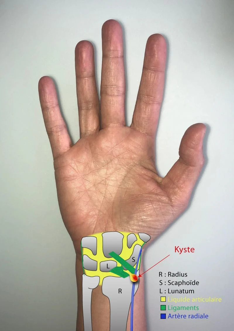 kyste-synovial-poignet