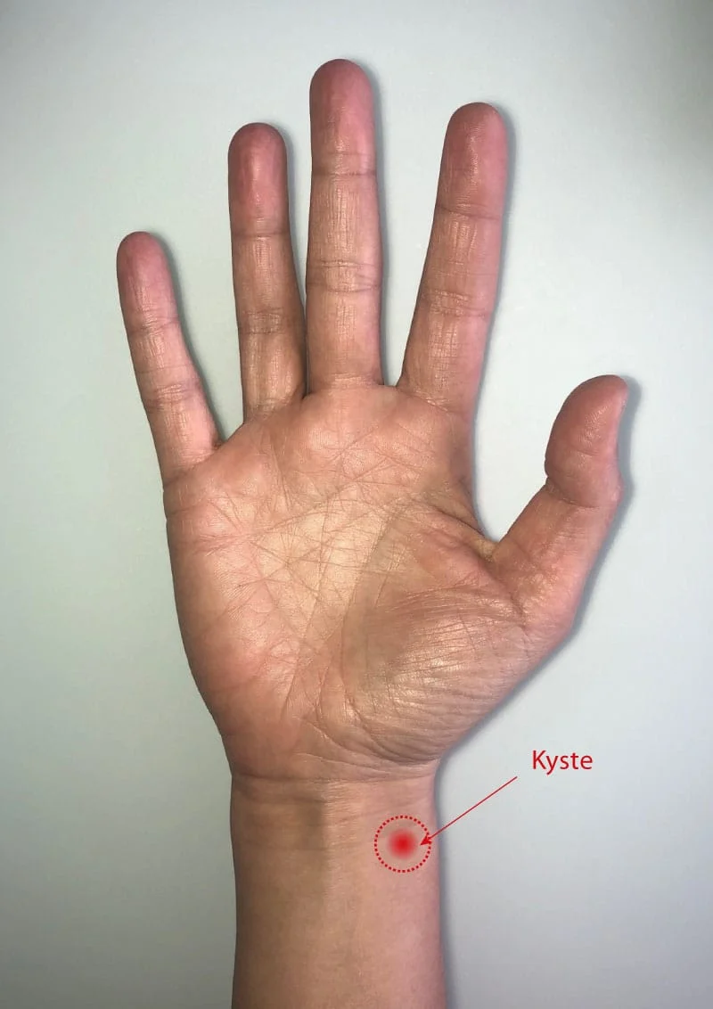 kyste-synovial-poignet