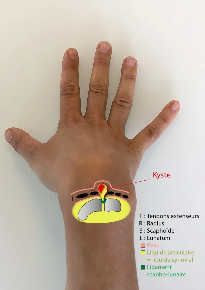 kyste-synovial-poignet-dorsal