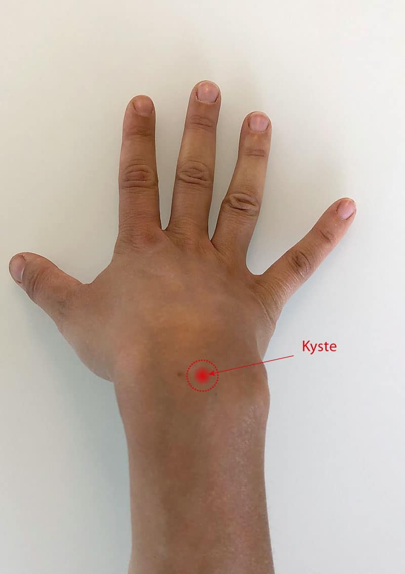 kyste-synovial-poignet-dorsal