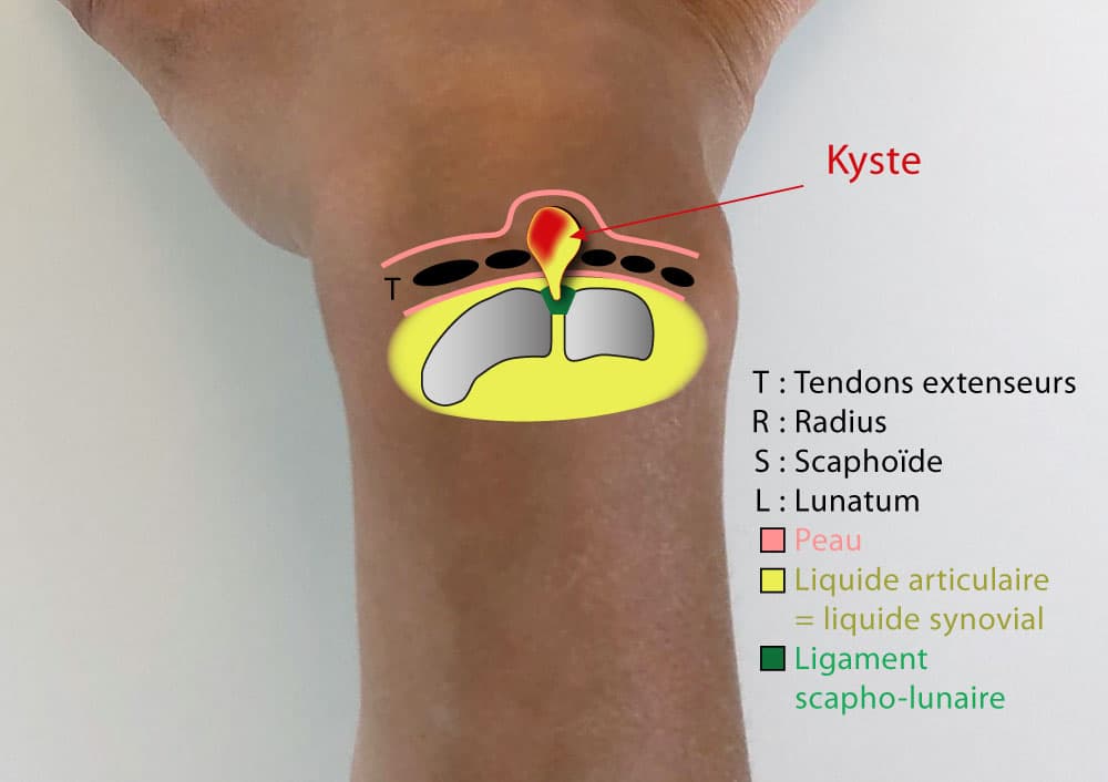 Le kyste synovial du poignet - IM2S