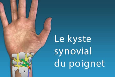 thumb-kyste-synovial