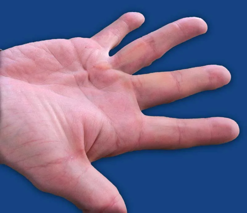 Dupuytren chirurgie-rachis-pdc