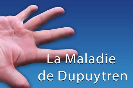 thumb-dupuytren