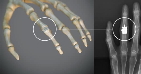 Prothèse de l’articulation inter-phalangienne proximale (IPP)