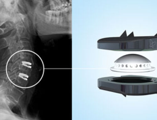 L’IM2S, une solide expérience en Prothèse Discale Cervicale