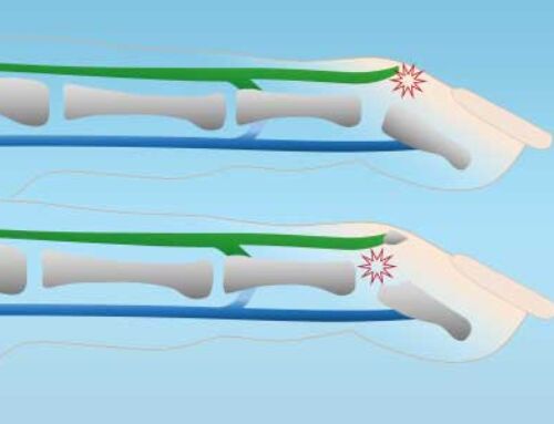 Le doigt en maillet – Mallet Finger