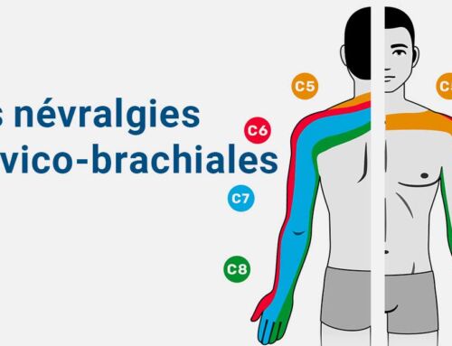 Les névralgies cervico-brachiales