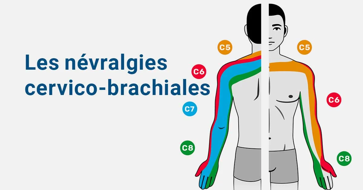 Les névralgies cervico-brachiales