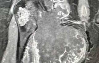 Amputation de type hémi-pelvectomie radicale chez une patiente atteinte d’un chondrosarcome envahissant du bassin