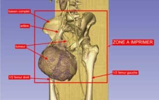Amputation de type hémi-pelvectomie radicale chez une patiente atteinte d’un chondrosarcome envahissant du bassin