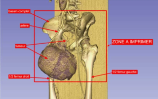 Amputation de type hémi-pelvectomie radicale chez une patiente atteinte d’un chondrosarcome envahissant du bassin