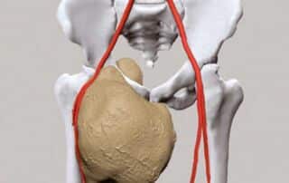 Amputation de type hémi-pelvectomie radicale chez une patiente atteinte d’un chondrosarcome envahissant du bassin